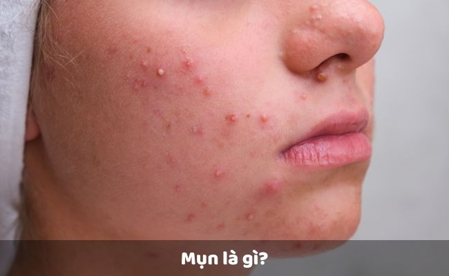 Mụn là gì?

