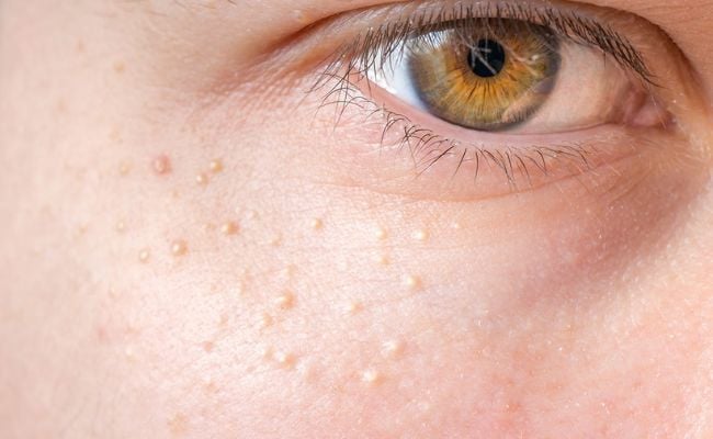 Nổi mụn nhỏ li ti trên mặt do yếu tố di truyền 