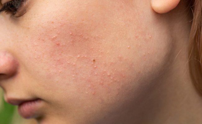 Mụn ẩn là gì? Dấu hiệu nhận biết mụn ẩn
