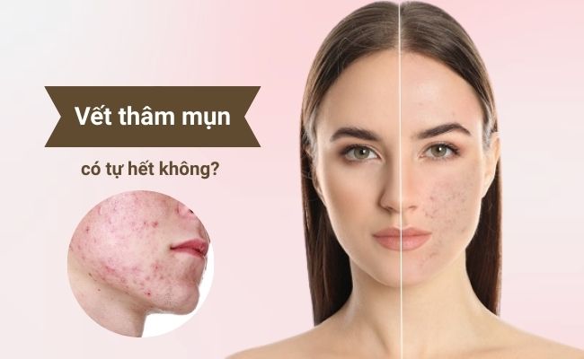 Thâm mụn có tự hết không?