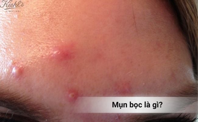 Mụn bọc là gì?
