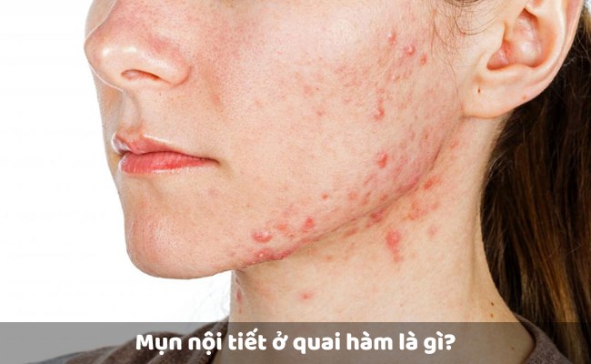 Mụn nội tiết ở quai hàm là gì?