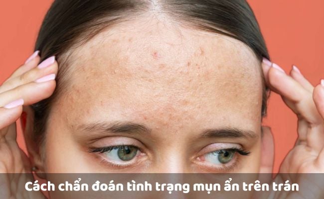 Cách chẩn đoán tình trạng mụn ẩn trên trán