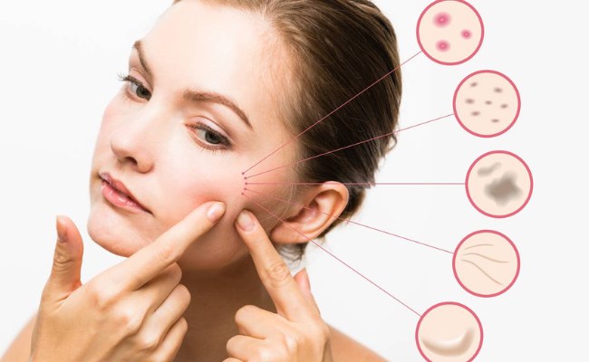 Cách chăm sóc da và phòng ngừa mụn bọc