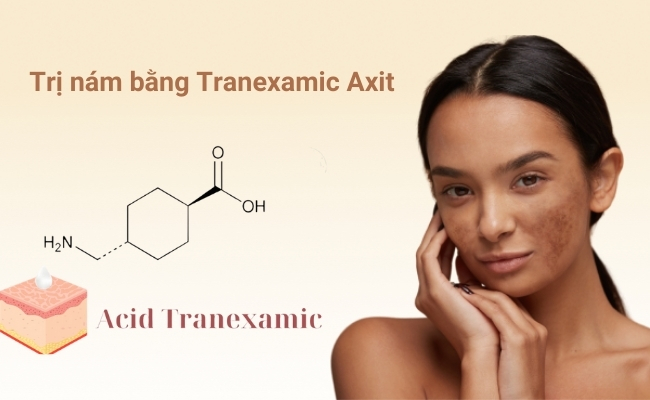 Cách trị nám bằng Tranexamic