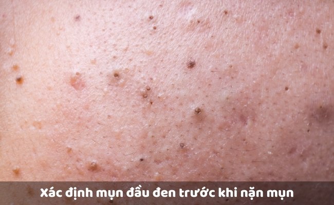 Cách nặn mụn đầu đen đúng cách

