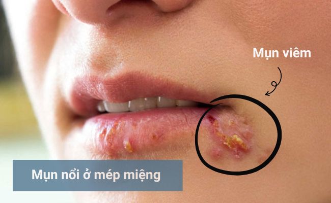 Nguyên nhân nổi mụn ở mép miệng?