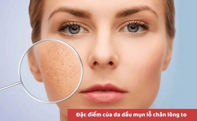 Đặc điểm của da dầu mụn lỗ chân lông to