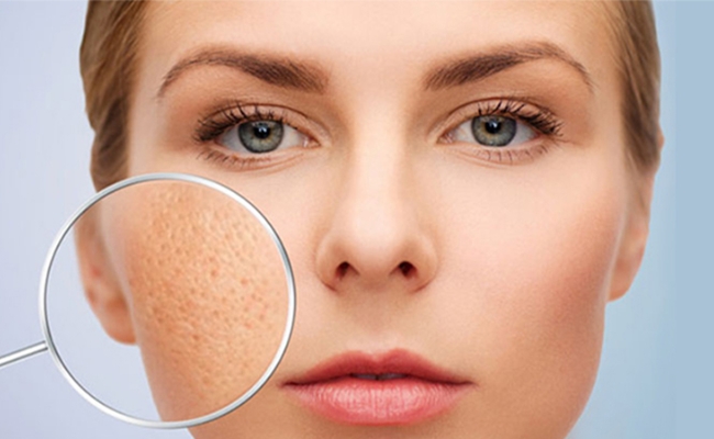 Azelaic Acid có tác dụng gì trong chăm sóc da