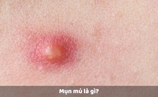 Mụn mủ là gì?