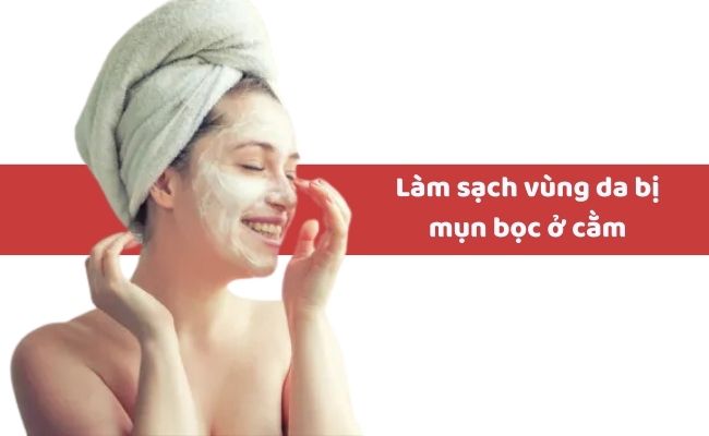 Cách điều trị mụn bọc ở cằm tại nhà?
