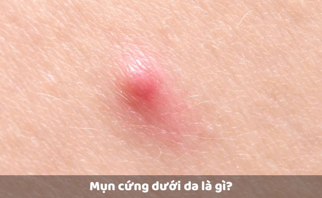 Mụn cứng dưới da là gì? Đặc điểm của mụn chai cứng dưới da
