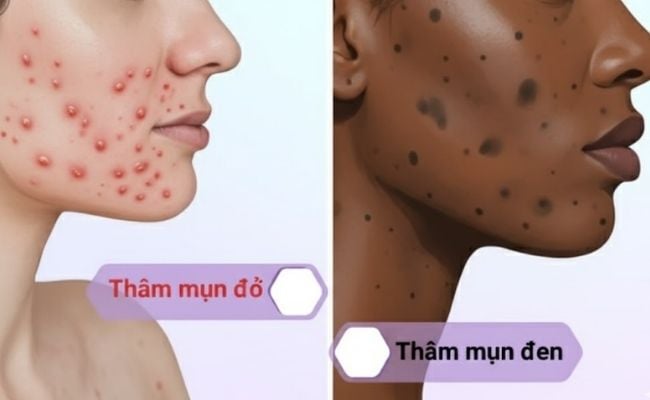 Thâm mụn là gì?