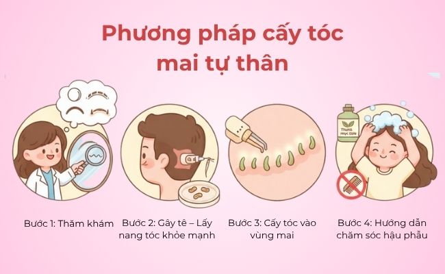 Phương pháp cấy tóc mai tự thân đang được ưa chuộng hiện nay
