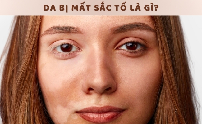 Da mất sắc tố là tình trạng bề mặt da bị suy giảm hoặc mất tạm thời sắc tố