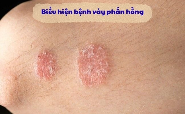 Biểu hiện bệnh vảy phấn hồng