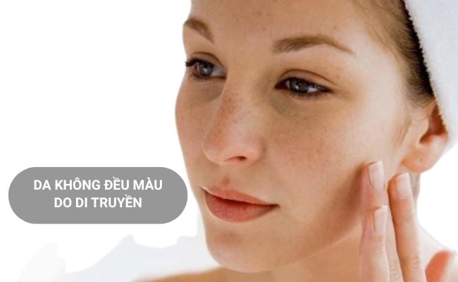 Nguyên nhân làm da không đều màu do di truyền