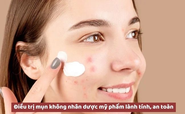 Cách trị mụn không nhân an toàn, hiệu quả