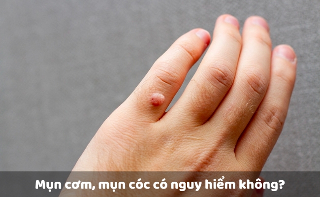 Mụn cơm là gì?
