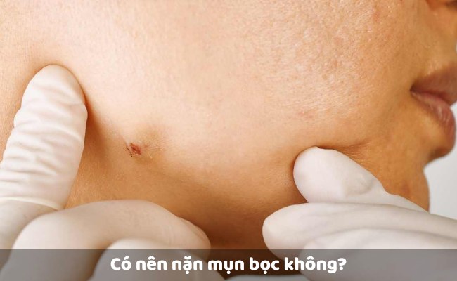 Có nên nặn mụn bọc không?