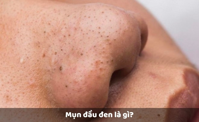 Mụn đầu đen là gì?