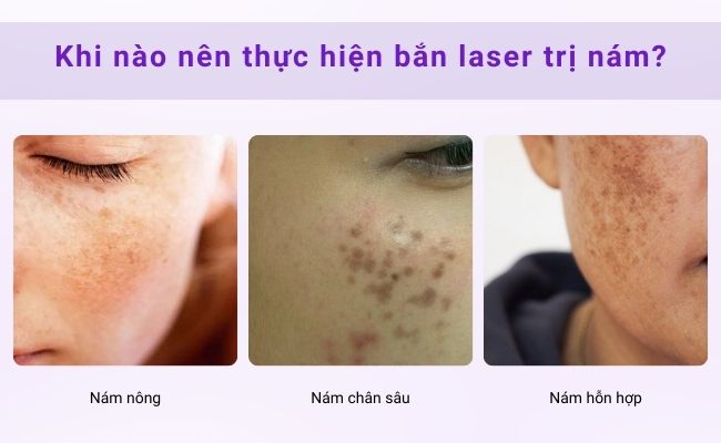Cần xác định chính xác loại nám trước khi điều trị bằng laser