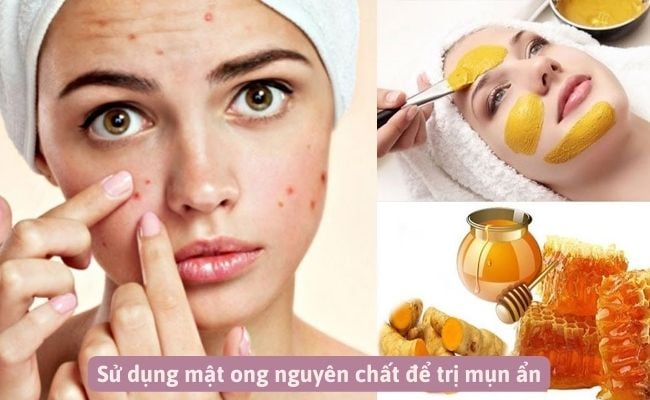 Mới nặn mụn xong nên làm gì để hết thâm sẹo?