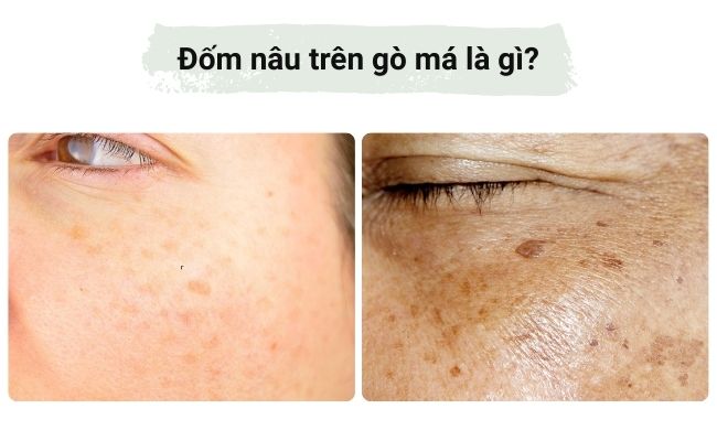Đốm nâu trên gò má là gì