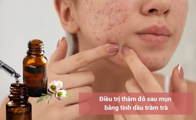 Tinh dầu tràm trà trị thâm đỏ sau mụn

