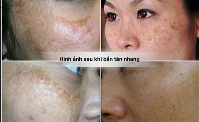 Hình ánh sau khi bắn tàn nhang