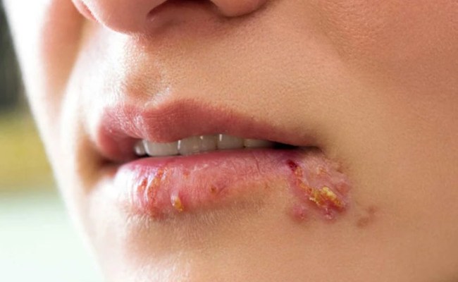 Nguyên nhân gây mụn ở từng vị trí trên mặt - Mụn trên miệng, môi