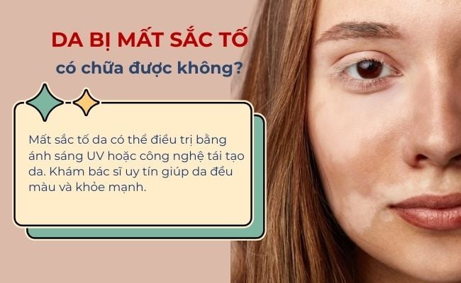Mất sắc tố da có chữa được không?