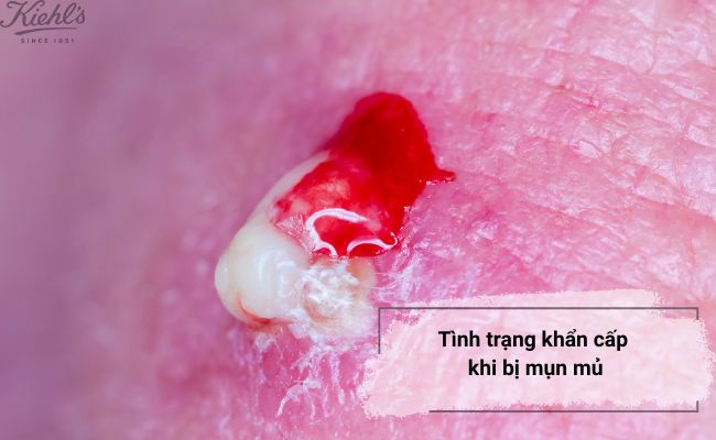 Tình trạng khẩn cấp khi bị mụn mủ