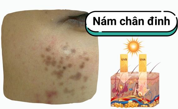 cải thiện nám da