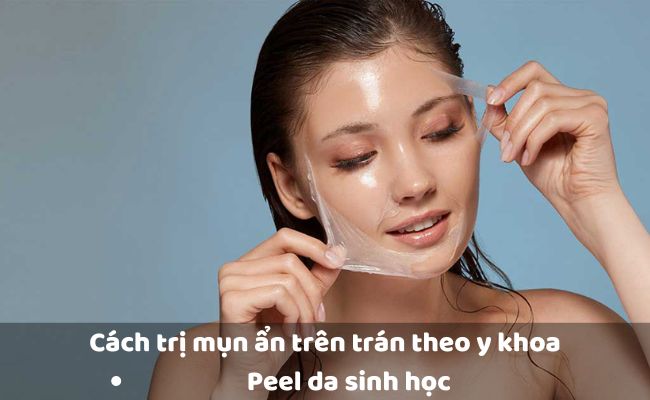 Peel da sinh học - Cách trị mụn ẩn trên trán theo y khoa