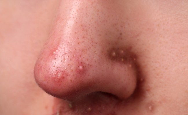 Mụn ở mũi - vị trí mụn nói lên điều gì?