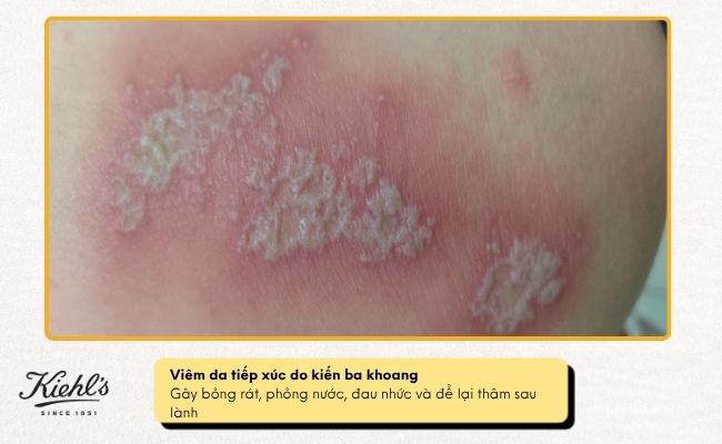 Viêm da tiếp xúc ánh sáng