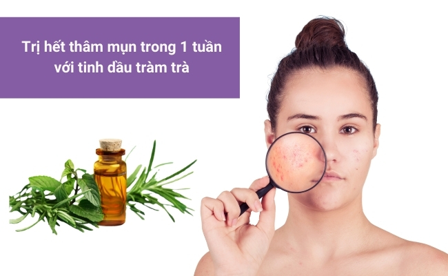 Thoa tinh dầu tràm trà giúp hết thâm mụn chỉ trong 1 tuần