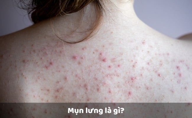 Mụn lưng là gì?

