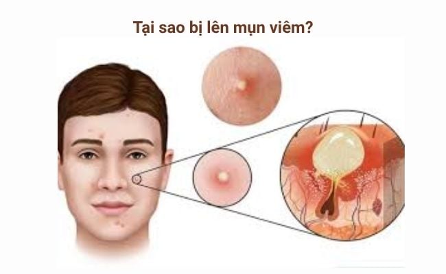 Nguyên nhân gây ra mụn viêm