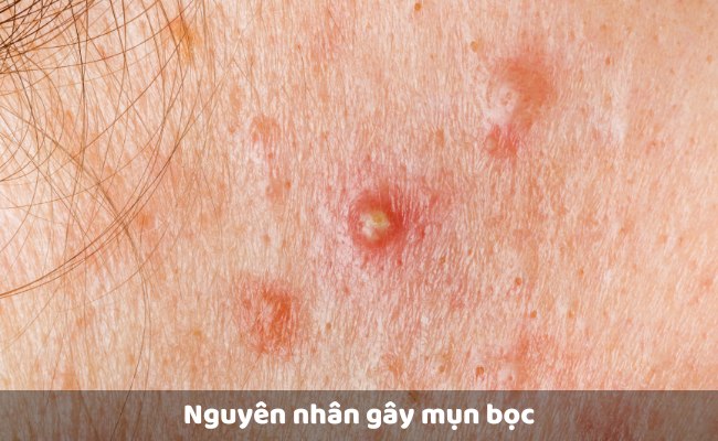 Nguyên nhân gây mụn bọc