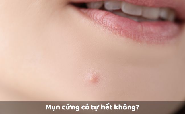 Mụn cứng có tự hết không?
