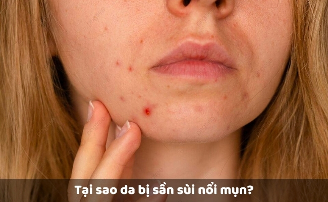Tại sao da bị sần sùi nổi mụn?