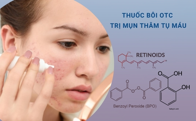 Thuốc bôi không kê đơn trị mụn thâm tụ máu