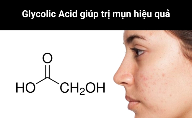 Glycolic Acid mang giúp trị mụn trứng cá Glycolic Acid mang lại hiệu quả trị mụn trứng cá