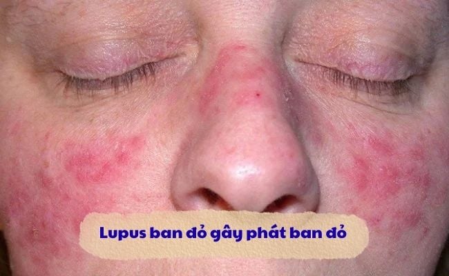 Lupus ban đỏ gây phát ban đỏ trên da
