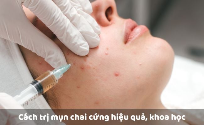 Tiểu phẫu mụn chai
 
  
