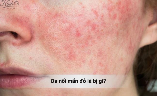 Da nổi mẩn đỏ là bị gì?