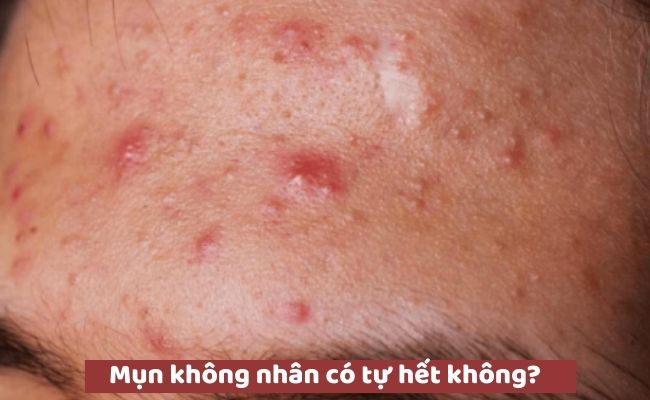 Mụn không nhân có tự hết không?