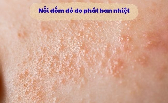 Nổi đốm đỏ trên da không ngứa do phát ban nhiệt